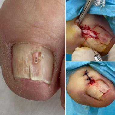 Czym jest fibroma?
