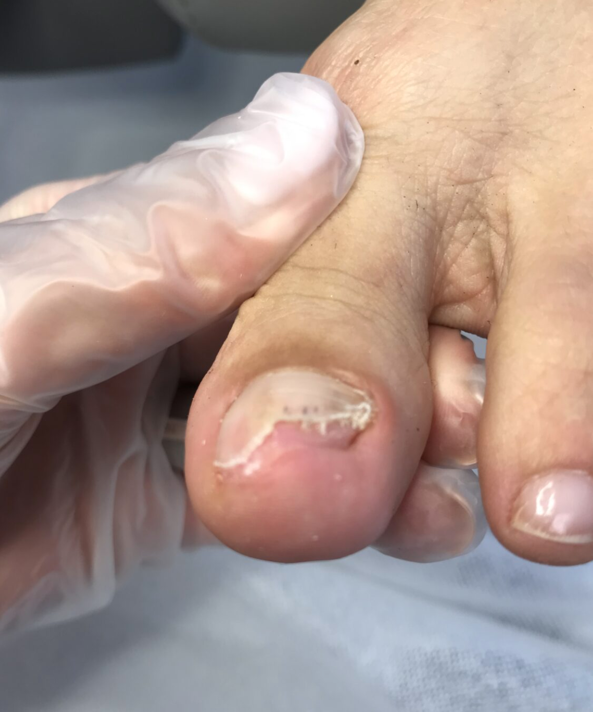 egzostoza podpaznokciowa terapia