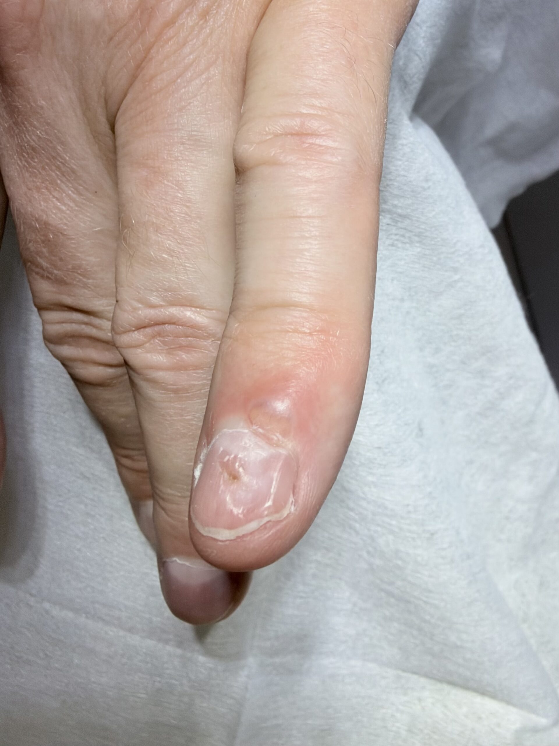 Ganglion – czym jest torbiel galaretowata?