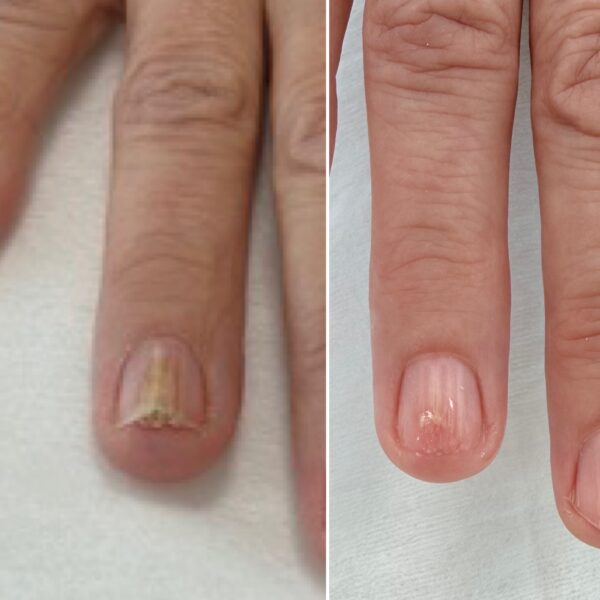 Dermatofity – najczęstsza przyczyna grzybicy stóp i paznokci